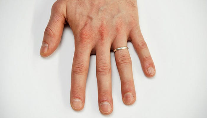 Vitaminmangel afsløres neglene - se her, hvilke vitaminer, du kan mangle